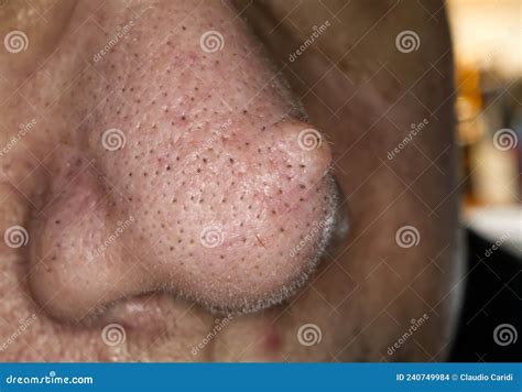 Female Nose with Wart or Papilloma. Macro Photo, Selective Focus Stock ...