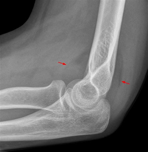 Supracondylar Humerus Fracture - Orthopedics - Medbullets Step 2/3