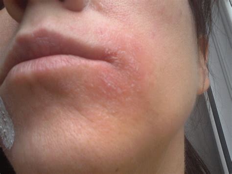 How To Stop Eczema Around Mouth at Kate Gask blog