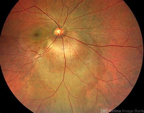 Choroidal Lesions Treatment | OCLI Vision