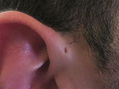 Bump or Lump in or Around the Ear: Causes and Treatments