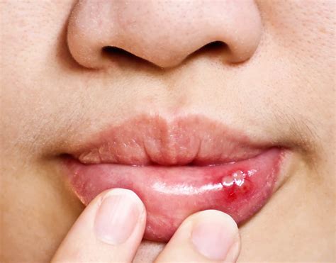 What Is Blood Blister In Mouth: Causes And Treatment