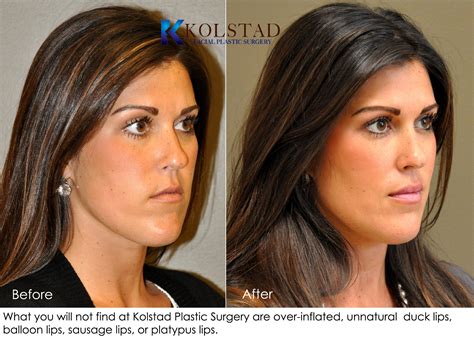 Lip Augmentation Before & After Gallery | Dr. Kolstad - San Diego Facial Plastic Surgeon