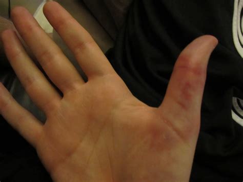 How To Tell If Your Thumb Knuckle Is Broken - Put me in a cast for 4 ...