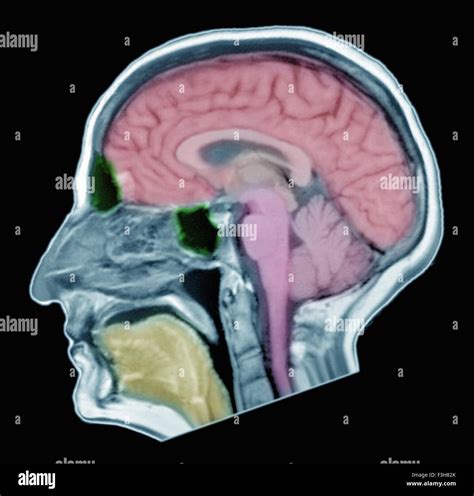 Normal brain mri hi-res stock photography and images - Alamy
