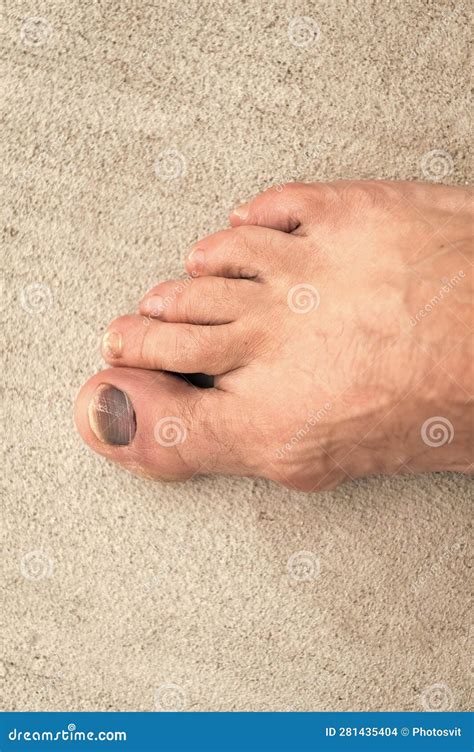 Closeup of Toe Nail Bruise Hemtoma. Toe Nail Bruise Hemtoma on Foot. Toe Nail Bruise Hemtoma ...
