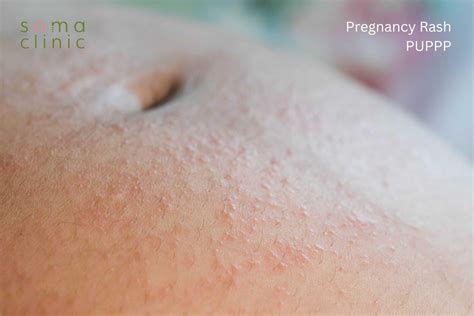 PUPPP: 7 Little-known Ways To Sooth Your Pregnancy Rash Without Using ...
