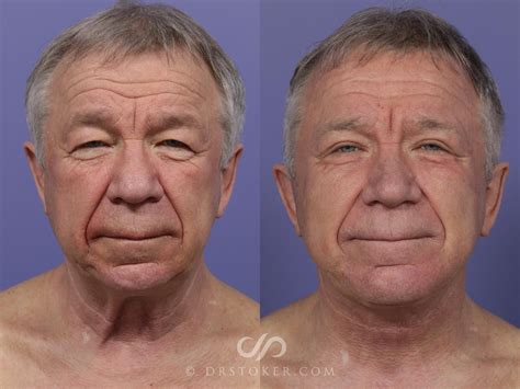 Men Facial Before And After