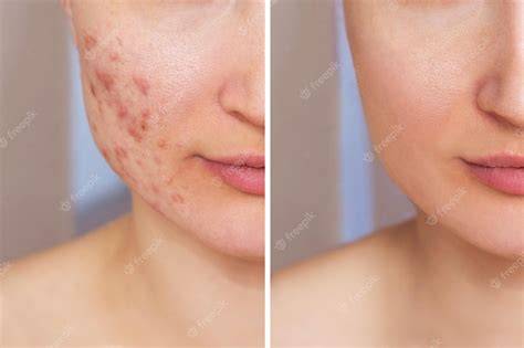 Revamin Acne Cream: The Ultimate Solution for Acne-Free Skin