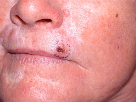 Basal Cell Carcinoma Early Stages