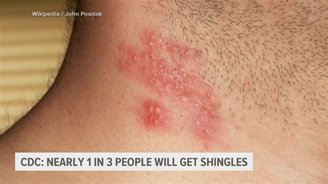 1 in 3 people to develop shingles in their lifetime | wqad.com