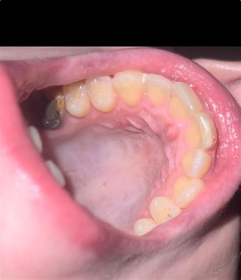 Sore roof of mouth : r/DentalHygiene