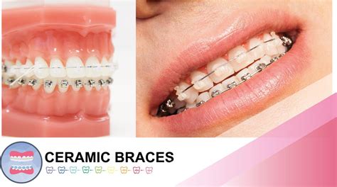 Clear Bracket Braces Ceramic Braces Bristol Tooth Coloured Ceramic