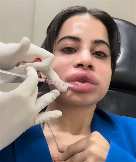Urfi Javed Face Surgery