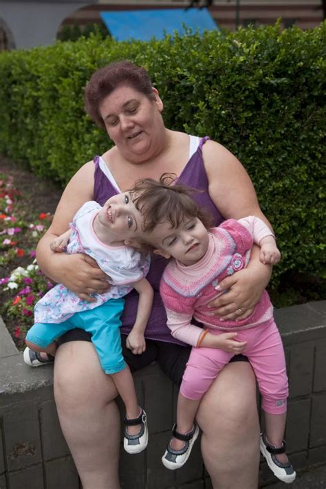 Inspirational tale of conjoined twins who will share sight, taste and ...