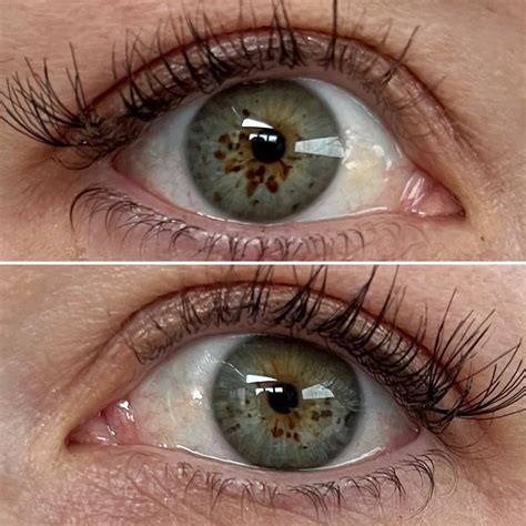 Nevus: Eye Freckles : r/eyes
