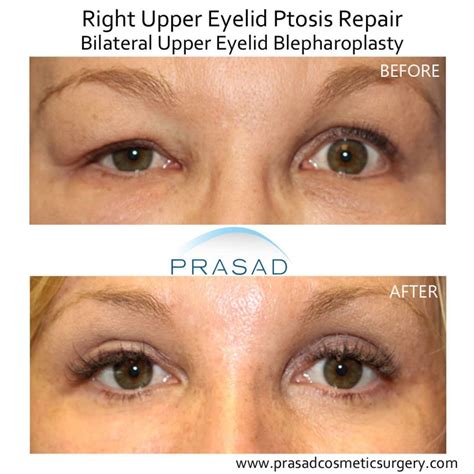 Droopy Eyelid Surgery: Eyelid Ptosis Procedure, and Recovery