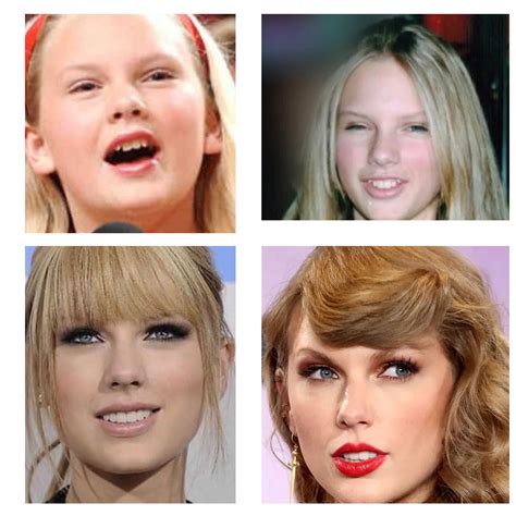 Taylor Swift Teeth - Best Cosmetic Dentistry in Antalya, Turkey
