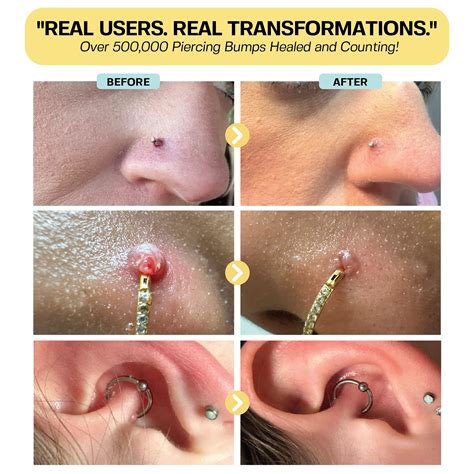 Snapklik.com : Piercing Bump Solution & Keloid Bump Removal Soothing ...