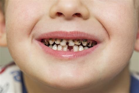 Tooth Decay in Children | A Detailed Analysis