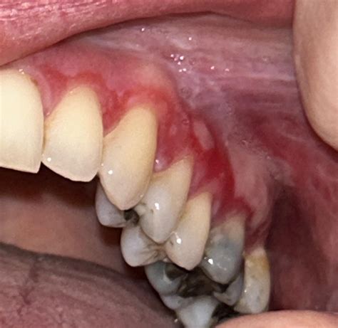Swollen discoloured gum : r/DentalHygiene