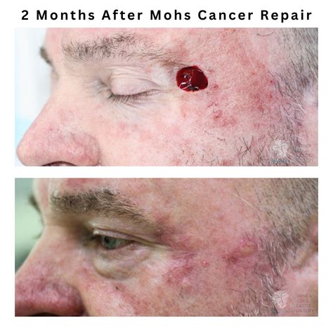 Mohs Procedure Before And After Skin Cancer Surgery Kirwan Plastic