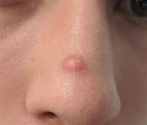 Red Bump On Nose