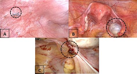Management of endometriosis: a call to multidisciplinary approach