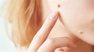 Types Of Skin Growths