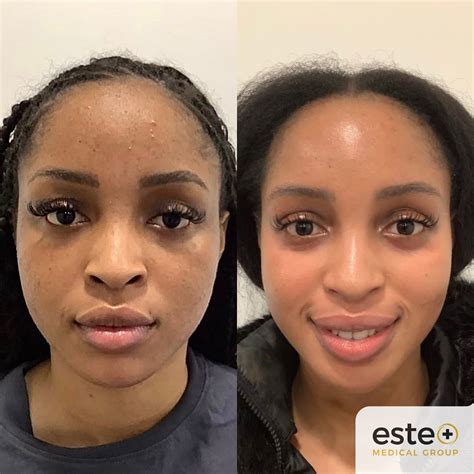 Hyperpigmentation Face Before And After
