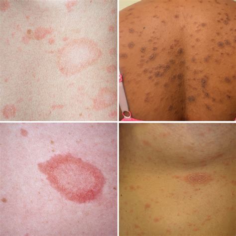 Pityriasis Rosea: Causes, Symptoms, and Natural Solutions – SkinFoodFix