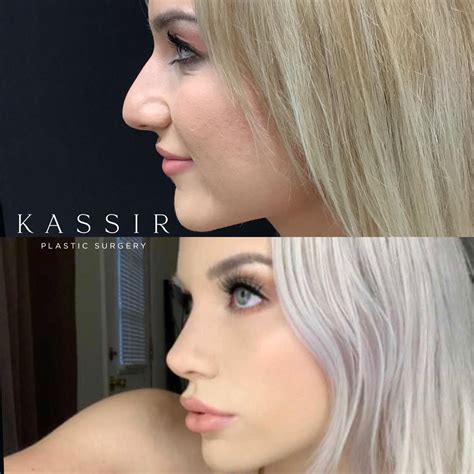 How much is a nose job in NJ — Kassir Plastic Surgery in NY and NJ