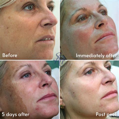 Medical Chemical Skin peels - Suffolk Medical & Beauty Clinic