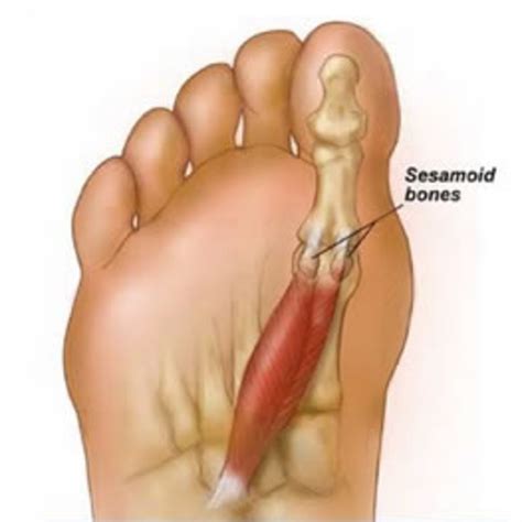 Sesamoiditis and the Sesamoid Bones | HubPages