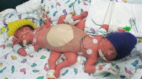 Conjoined at birth, now separated: 8 amazing years later