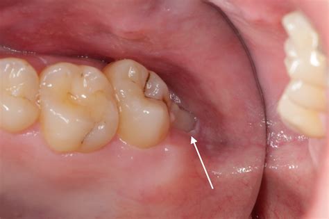 Partially Erupted Wisdom Tooth