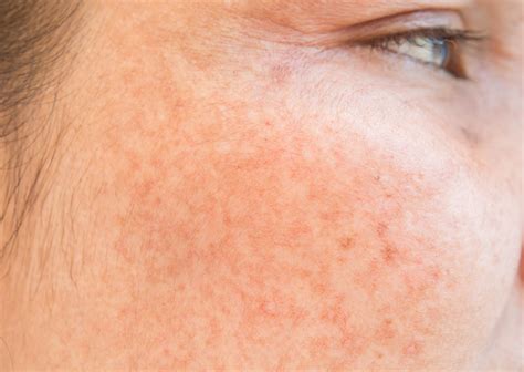 Will The Sunbed Help My Spots at Skye Milliner blog