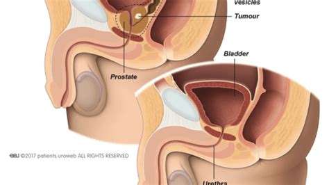 Robotic Prostate Surgery: What to Expect and Preparation | Advanced Urology
