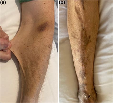 The role of cutaneous manifestations in the diagnosis of the Ehlers‐Danlos syndromes ...