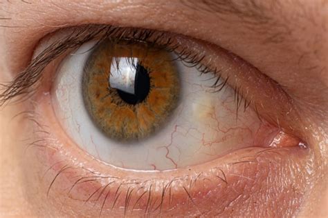 Pinguecula (Yellow Bump on Eyeball): Diagnosis, Causes & Treatment ...
