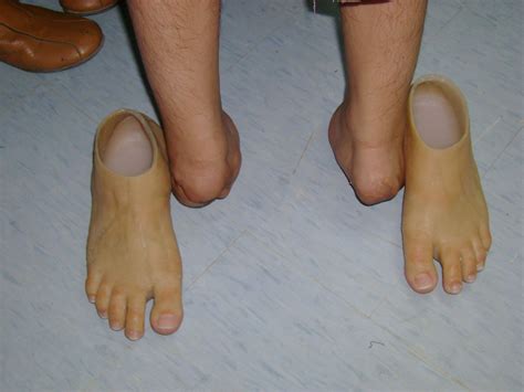 Types Of Foot Prosthetics at Amy Dieter blog