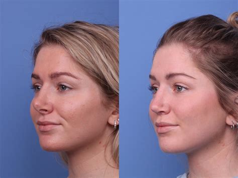 What Happens If You Sniff After Rhinoplasty at Katherine Roosa blog