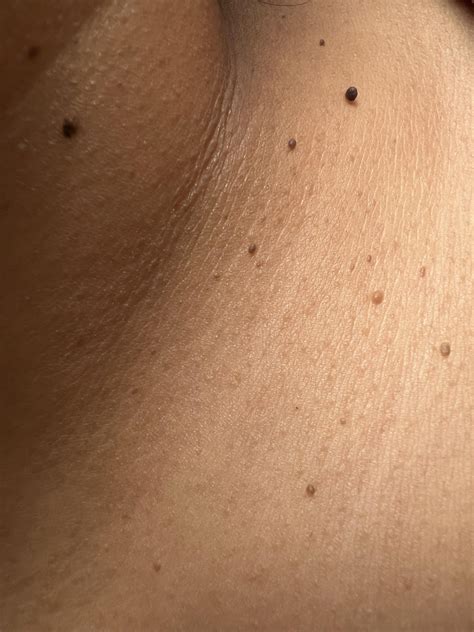 Skin Tags On Neck