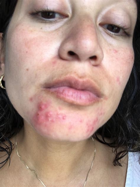 Mild Cystic Acne Chin
