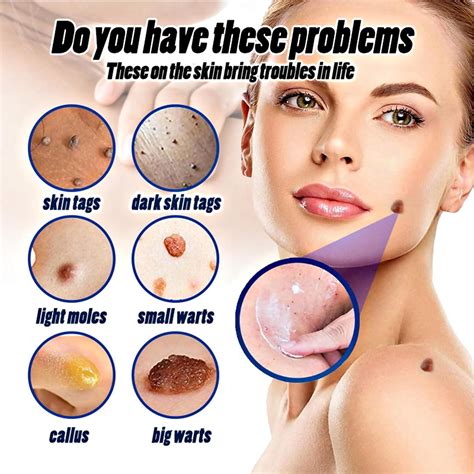 Wart Removal Cream 20g Effective Treatment of Warts Corns Spot Moles Moles and Calluses Suitable ...