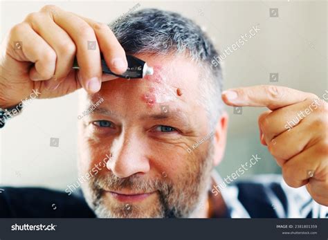 Man Herpes Zoster Shingles On Face Stock Photo 2381801359 | Shutterstock