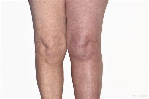 How a Knee Wrap Can Help Treat a Baker Cyst – Torreng Labs