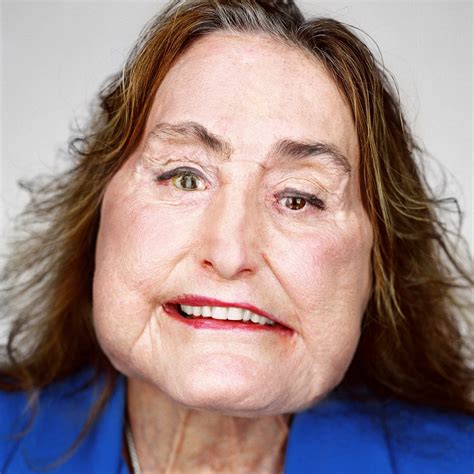 How a Face Transplant Transformed a Young Woman’s Life