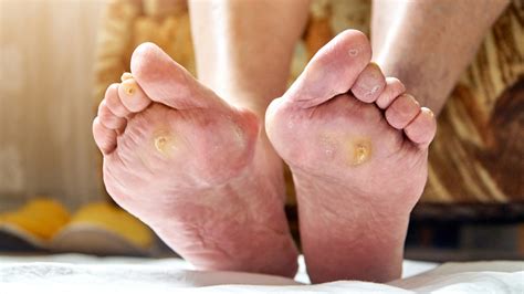 How to Get Rid of Plantar Callus: Effective Treatment Tips