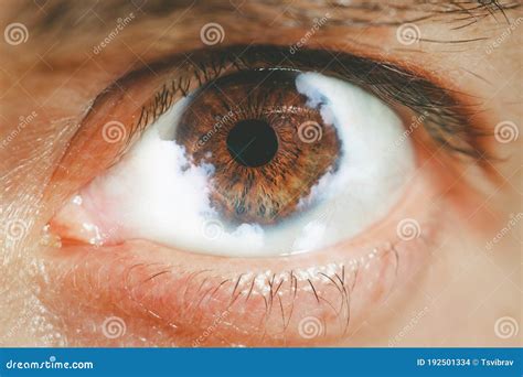 Human Eye with Clouds - Cloudy Vision Concept. Stock Photo - Image of ...
